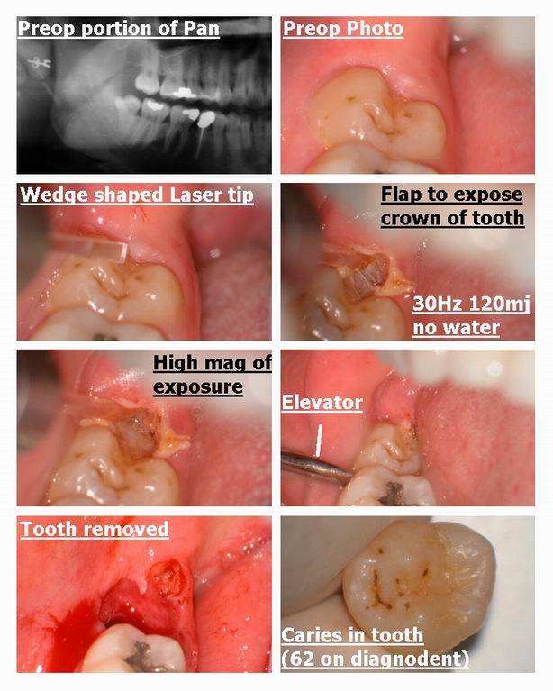 Extraction of 3rd molar.jpg